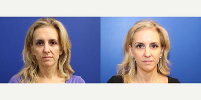 Restylane before and after photo