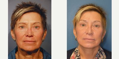 Brow Lift before and after photo