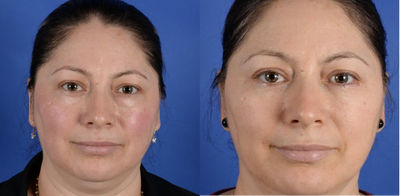 Eyelid Surgery before and after photo