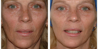 Microneedling before and after photo