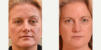 Skin Rejuvenation before and after photo