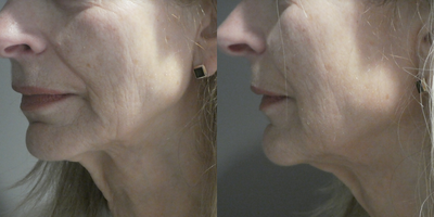Ultherapy before and after photo