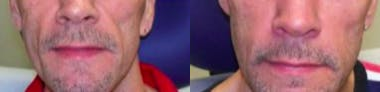 Voluma before and after photo