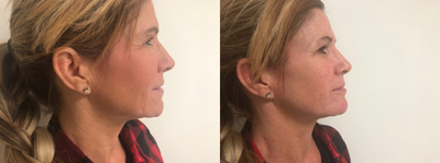Botox before and after photo