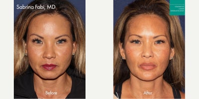 Botox before and after photo