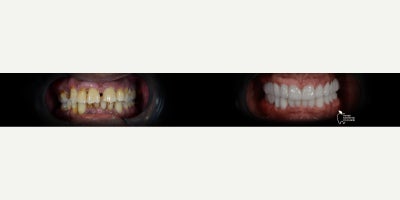 Dental Implants before and after photo
