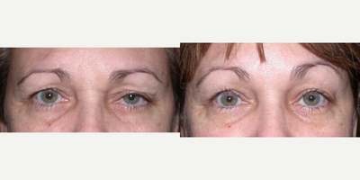 Eyelid Surgery before and after photo