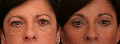 Facelift before and after photo