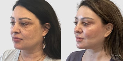 Facelift before and after photo