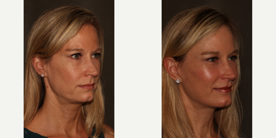 Lower Facelift before and after photo