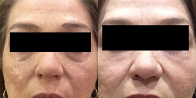 Restylane before and after photo