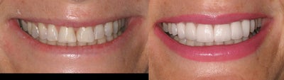 Smile Makeover before and after photo