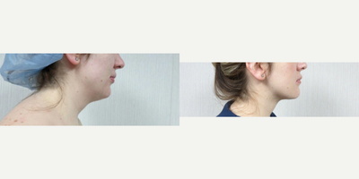 Chin Liposuction before and after photo