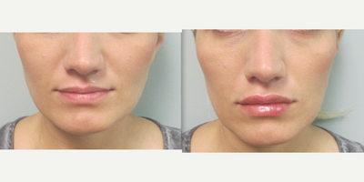 Dermal Fillers before and after photo