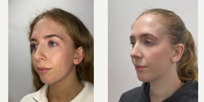 Genioplasty before and after photo