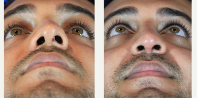 Rhinoplasty before and after photo