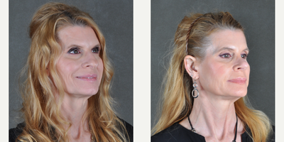 Rhinoplasty before and after photo