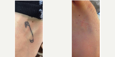 Tattoo Removal before and after photo