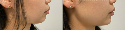 Chin Filler before and after photo