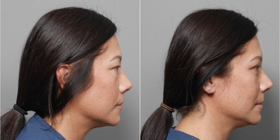 Eyelid Surgery before and after photo