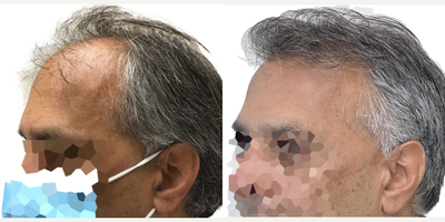 Hair Transplant before and after photo