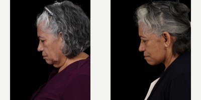 Neck Lift before and after photo