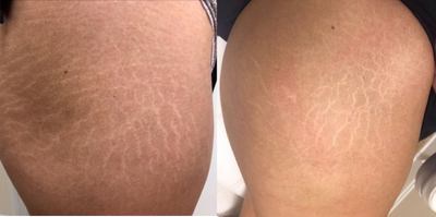 PRP Injections before and after photo
