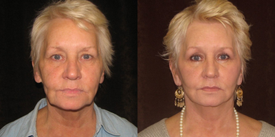 Facelift before and after photo