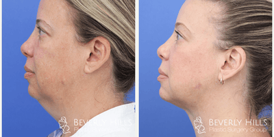 FaceTite before and after photo