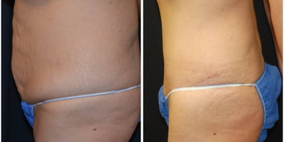 Tummy Tuck before and after photo