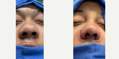 African American Rhinoplasty before and after photo