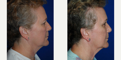 Brow Lift before and after photo