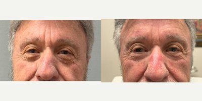 Chemical Peel before and after photo