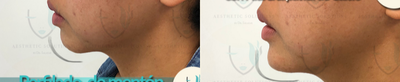 Chin Filler before and after photo