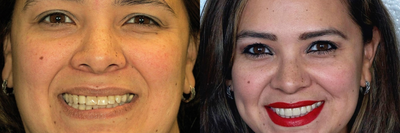 Dental Crown before and after photo