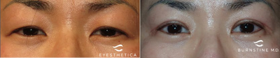 Double Eyelid Surgery before and after photo