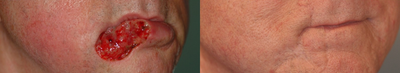 Facial Reconstructive Surgery before and after photo