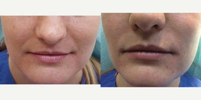 Juvederm before and after photo