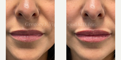 Lip Fillers before and after photo