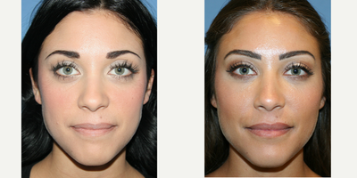 Lip Surgery before and after photo