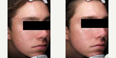 Morpheus8 before and after photo
