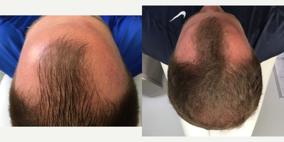 PRP for Hair Loss before and after photo