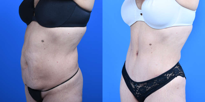 Tummy Tuck before and after photo