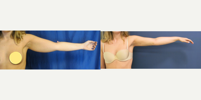 Arm Lift before and after photo