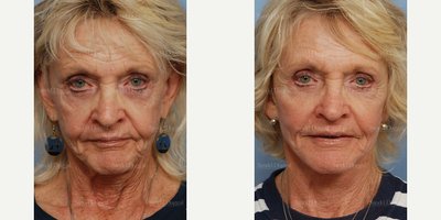 Cheek Augmentation before and after photo