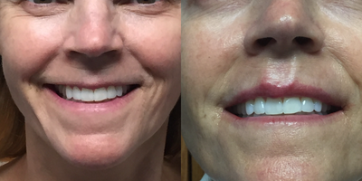 Dermal Fillers before and after photo