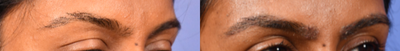 Eyebrow Transplant before and after photo