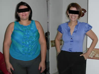 Gastric Sleeve Surgery before and after photo