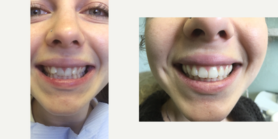 Invisalign before and after photo