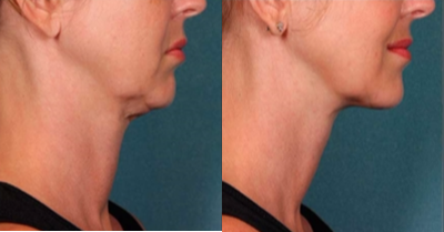 Kybella before and after photo